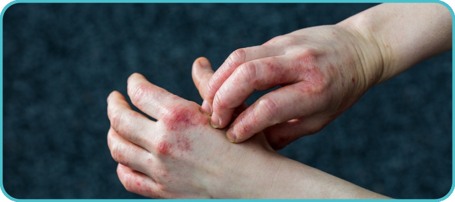 Weeping eczema can be distressing for both children and parents, especially when the skin appears inflamed, wet, and irritated. This condition is not uncommon in pediatric patients and often signals that eczema has progressed to a more severe stage. At Healing Care Pediatrics, children receive attentive, personalized care under the guidance of Dr. Khanum Saleha, who focuses on identifying the root cause and providing effective relief for uncomfortable skin conditions like weeping eczema.