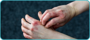 Weeping eczema can be distressing for both children and parents, especially when the skin appears inflamed, wet, and irritated. This condition is not uncommon in pediatric patients and often signals that eczema has progressed to a more severe stage. At Healing Care Pediatrics, children receive attentive, personalized care under the guidance of Dr. Khanum Saleha, who focuses on identifying the root cause and providing effective relief for uncomfortable skin conditions like weeping eczema.